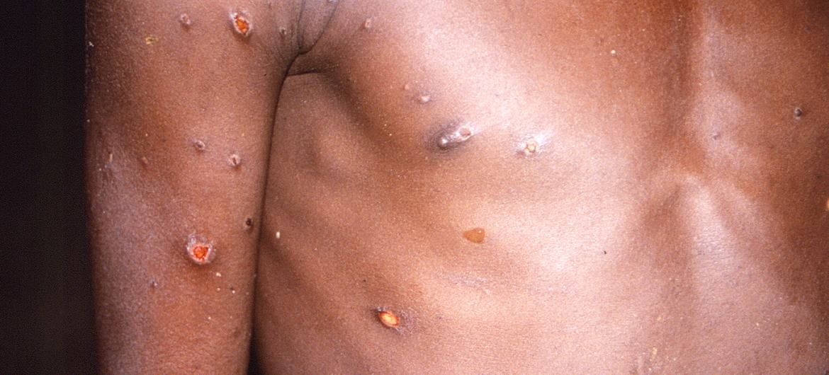 Monkeypox produces skin lesions, fever, and body aches in people affected with the virus.